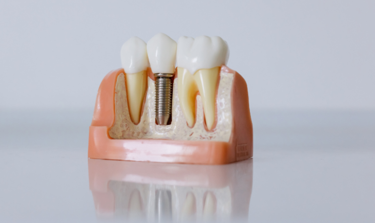 Why More Patients Choose Dental Implants at North York Clinics